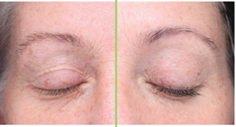 CACI SPED Before and After treatment