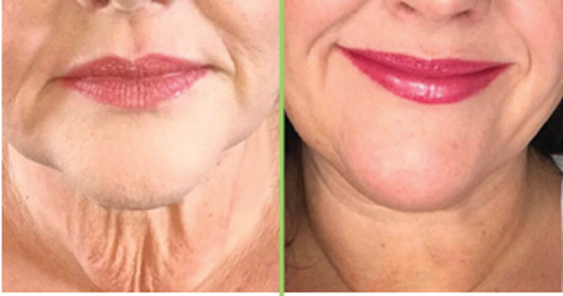 CACI SPED Before and After treatment