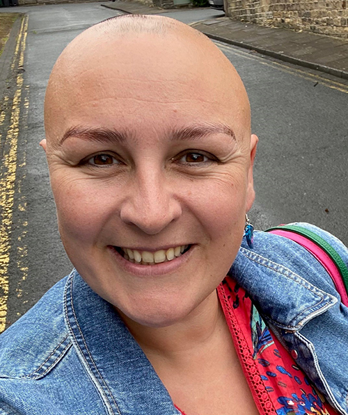 Amy Johnson Alopecia UK