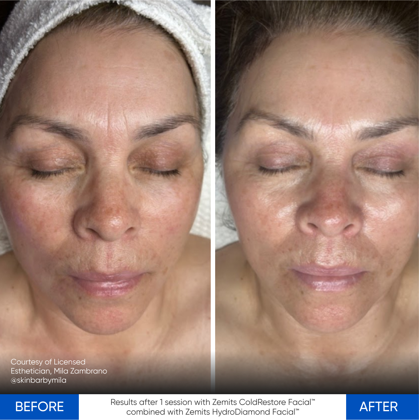 Case Study using Zemits CryoElegance