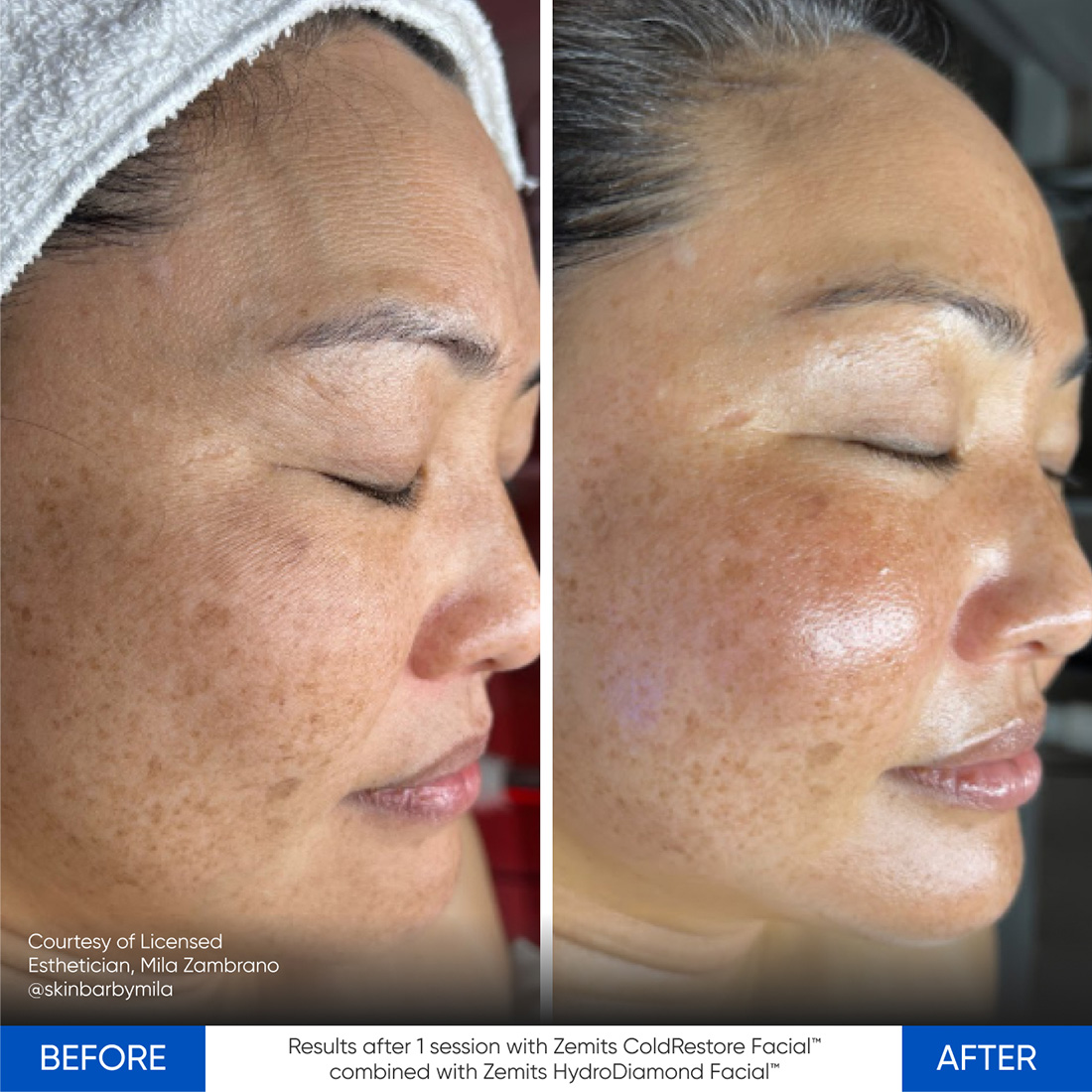 Case Study using Zemits CryoElegance